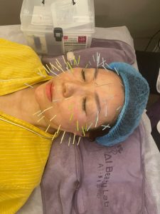 中醫面部埋線除紋
