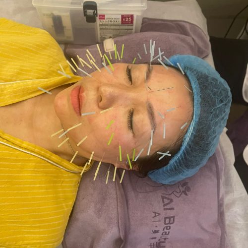 中醫面部埋線除紋